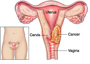 سرطان عنق الرحم (cervical cancer)