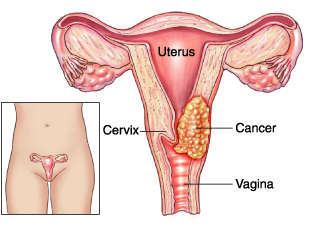 سرطان عنق الرحم (cervical cancer)