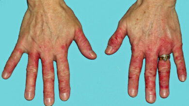 الحساسية الجلدية (skin allergy)