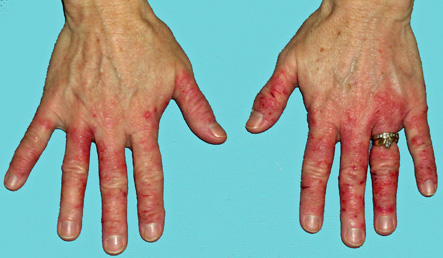 الحساسية الجلدية (skin allergy)